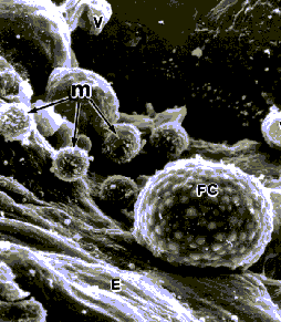 A fatty
                foam cell (FC) containing oxidised cholesterol
